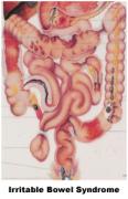 El síndrome del Intestino Irritable y la fibra soluble (IBS)